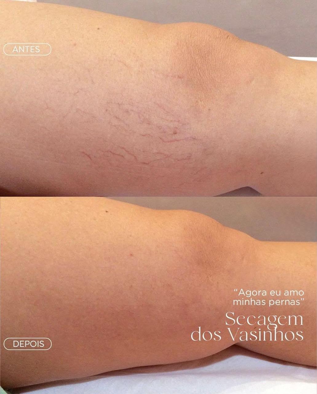 Tratamento de microvasos, resultado nas pernas